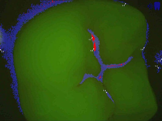 CamX Spectra tooth scan