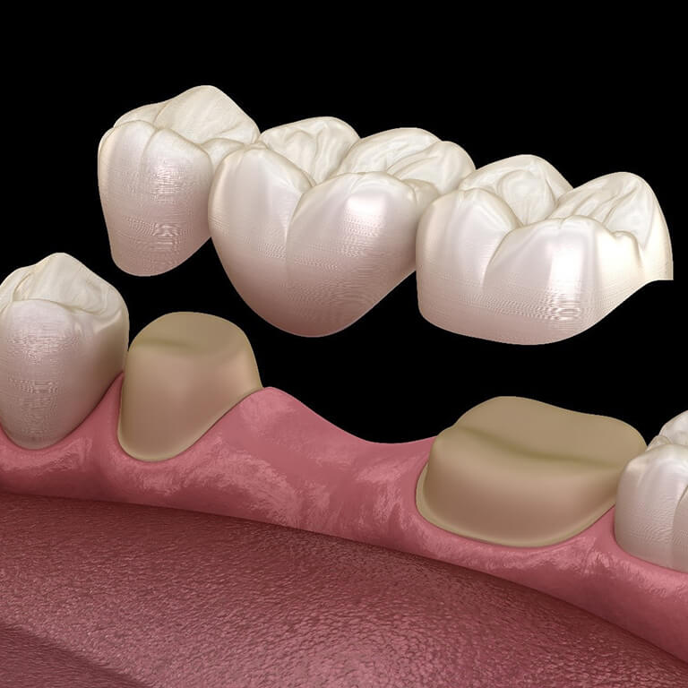 dental bridge illustration