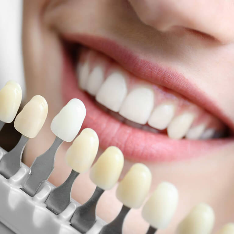 teeth whitening samples