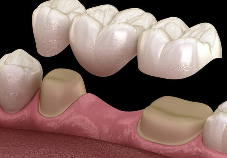 dental bridge illustration