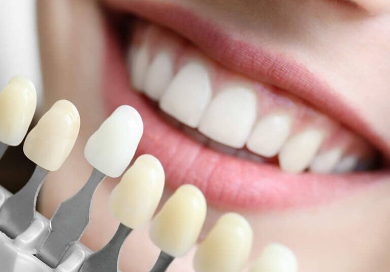 teeth whitening samples